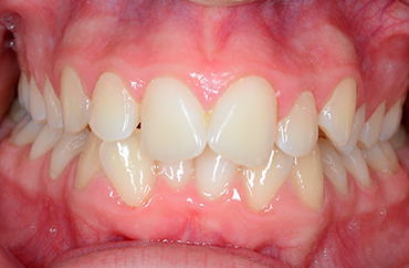 Πριν την ορθοδοντική θεραπεία συνωστισμού δοντιών εφήβου