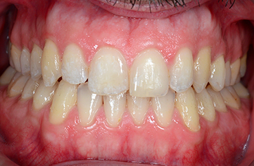 Μετά την ορθοδοντική θεραπεία προγναθισμού και σταυροειδούς σύγκλεισης δοντιών ενήλικα