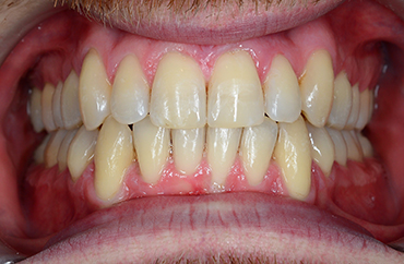 Μετά την ορθοδοντική θεραπεία συνωστισμού και έκτοπων δοντιών ενήλικα