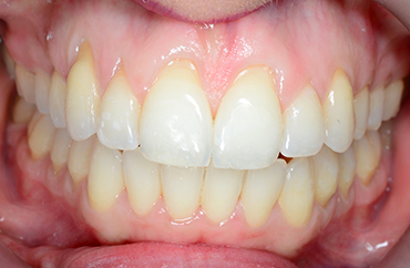 Μετά την ορθοδοντική θεραπεία χασμοδοντίας και συνωστισμού δοντιών ενήλικα